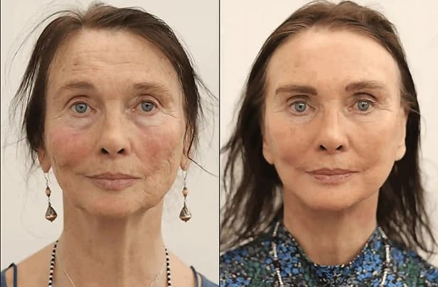 Before & After Photo