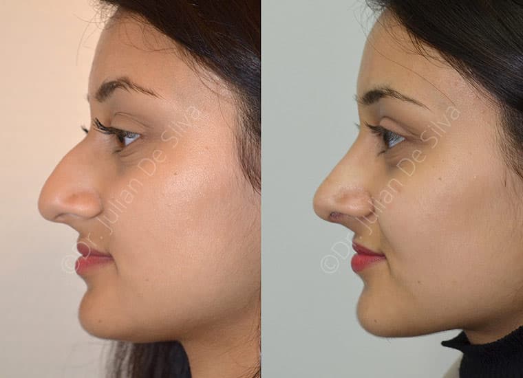 What Facelift Surgery Can Treat