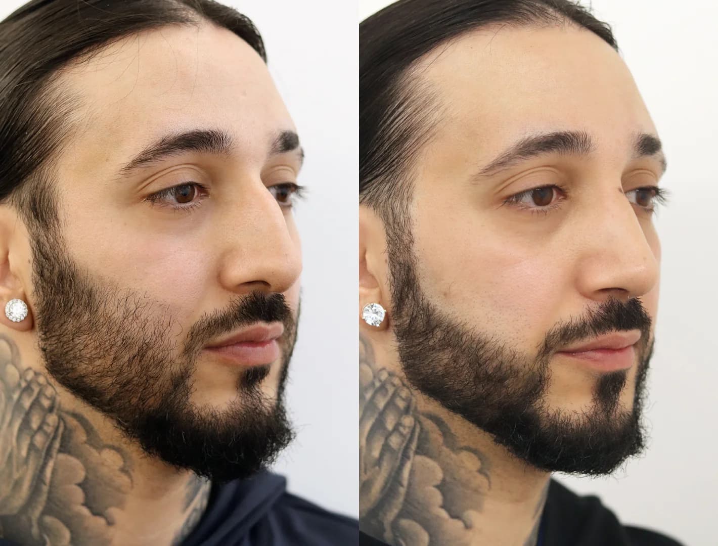 male nose job: man with balanced nose profile