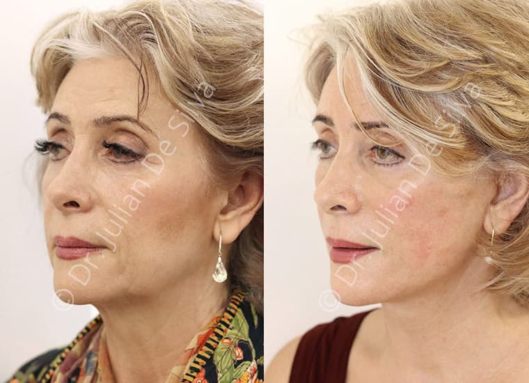 What Facelift Surgery Can Treat