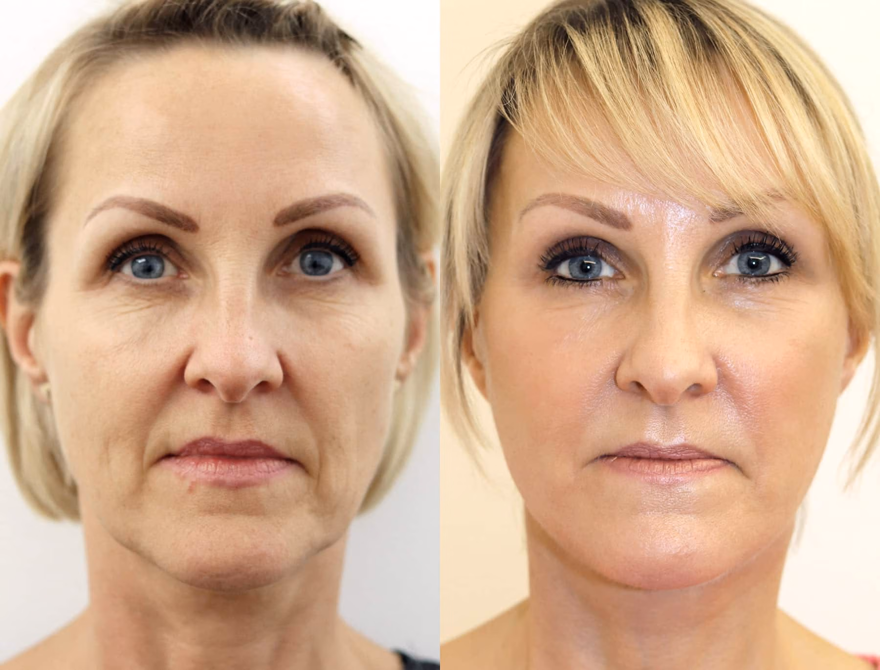 What Facelift Surgery Can Treat