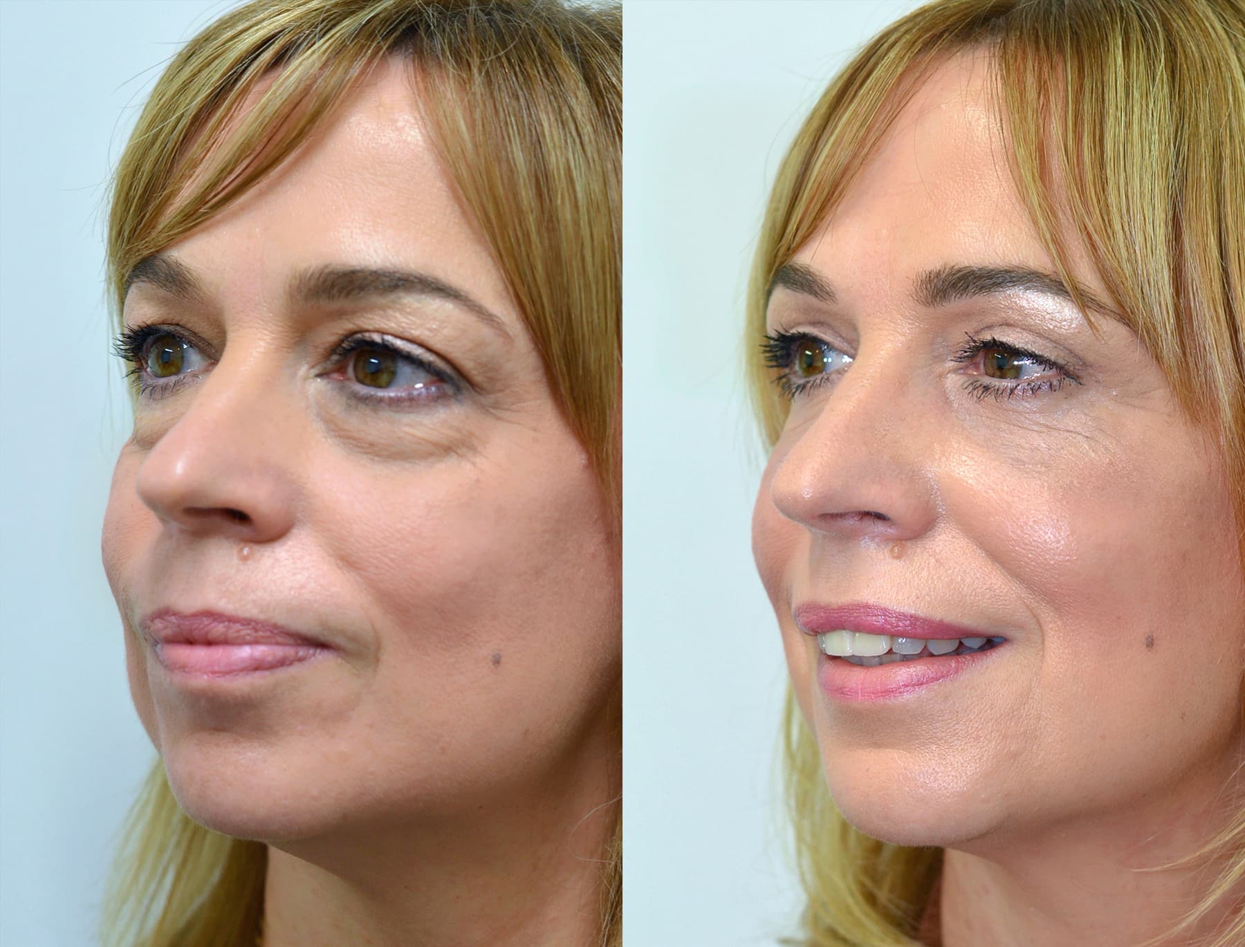 What Can Be Treated with a Harley Street Blepharoplasty?