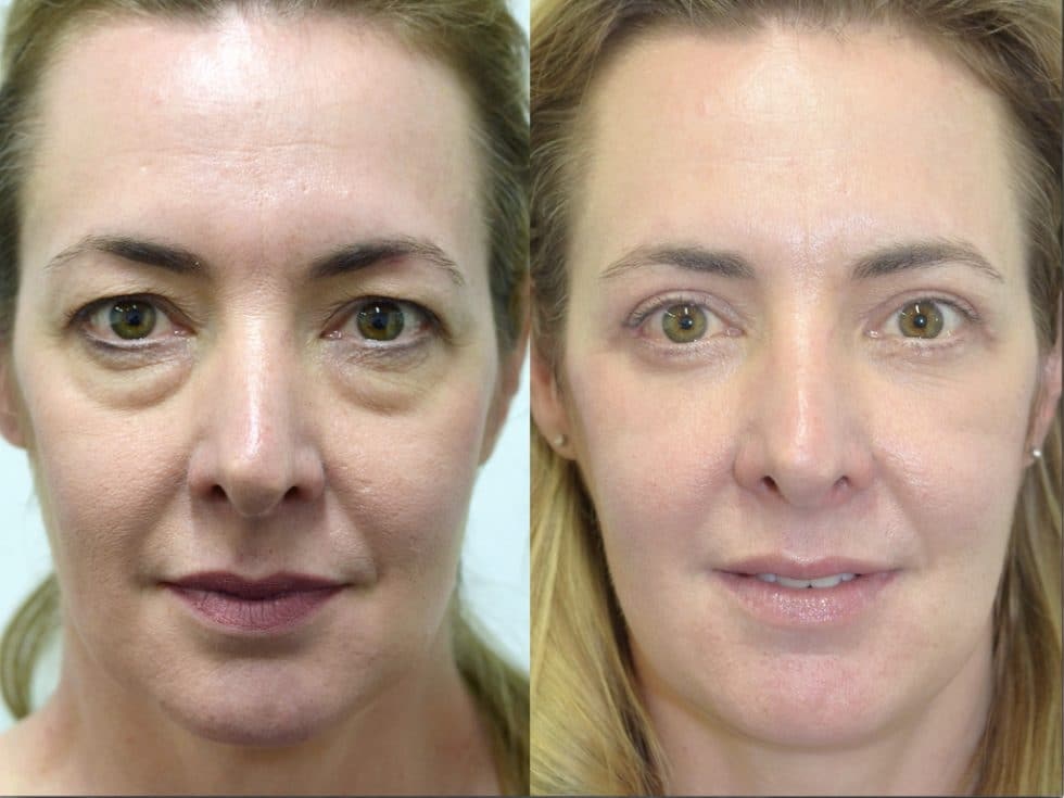 Blepharoplasty Before and After