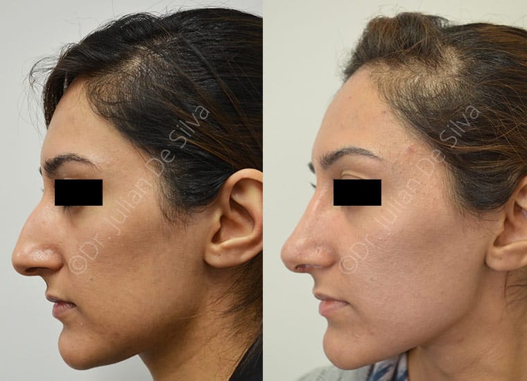 Ethnic Nose Surgery London | Harley Street | Rhinoplasty image 8