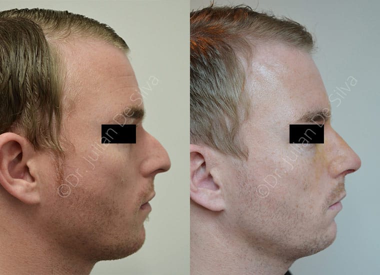 Revision Rhinoplasty London | Corrective Nose Job image 7