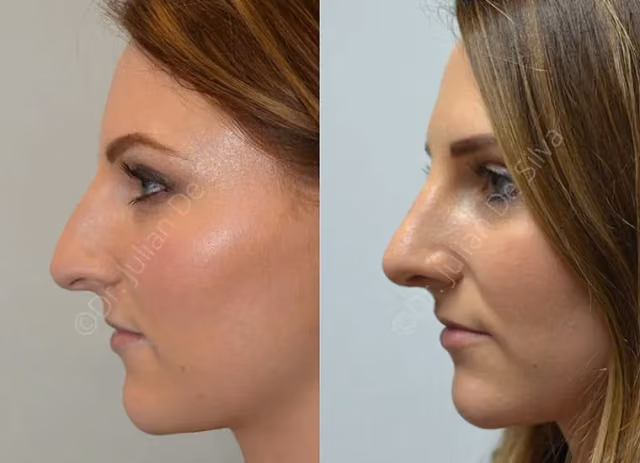 Revision Rhinoplasty Patient 2