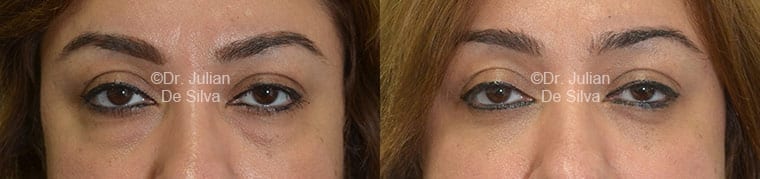 Ethnic Blepharoplasty London | Eyelid Surgery For Ethnic Patients image 7