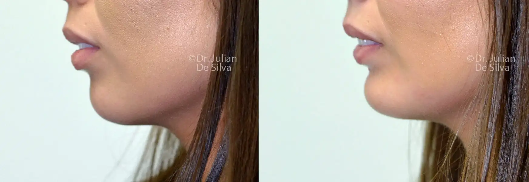 Chin Impant Before & Afters