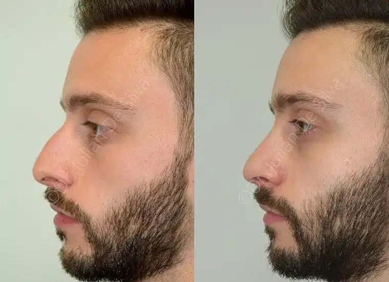 View rhinoplasty Gallery