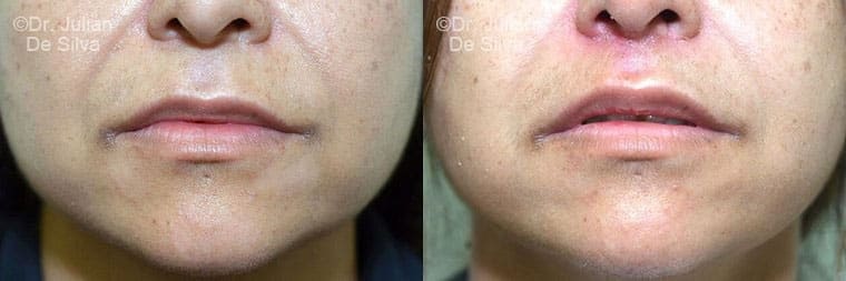 Lip Augmentation & Reduction Before & After Results in London