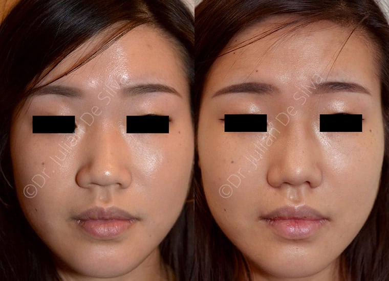 Before & After Procedure