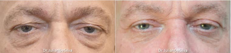 Male Blepharoplasty London | Revision Blepharoplasty For Men image 7