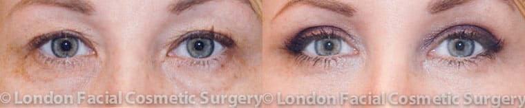 Photo of the patient’s eyes before and after the Blepharoplasty surgery. Patient 1 - Set 1