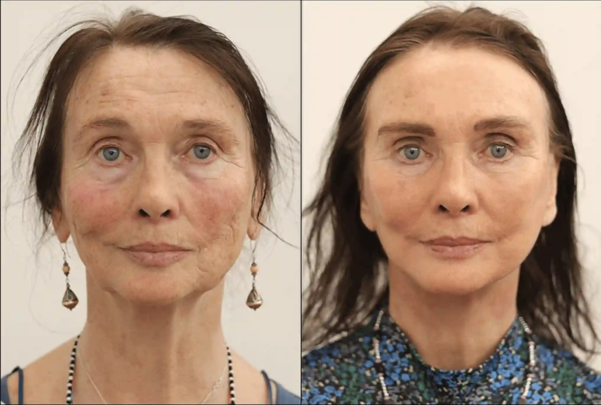Patient face, before and after Facelift treatment, front view, patient 7