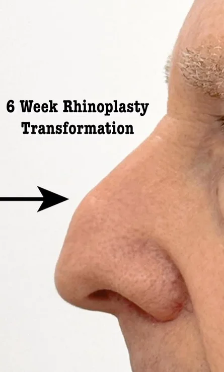 men's rhinoplasty: male patient being marked for nose job