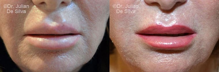 Lip Augmentation & Reduction Before & After Results in London