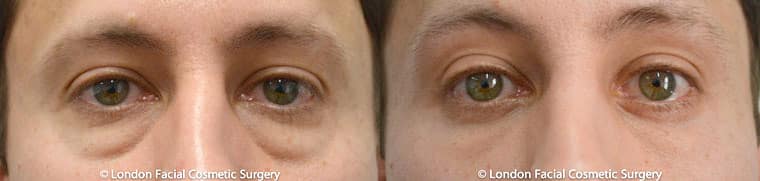 Photo of the patient’s eyes before and after the Blepharoplasty surgery. Patient 5 - Set 1