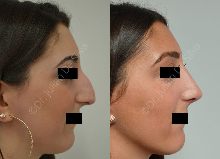 Rhinoplasty in London Before & After Results