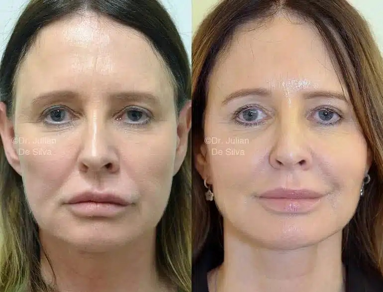 View FAcelift Gallery