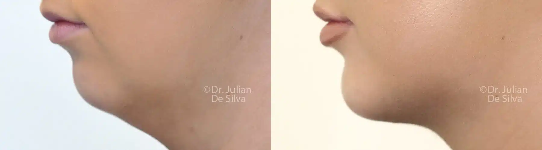 Chin Impant Before & Afters
