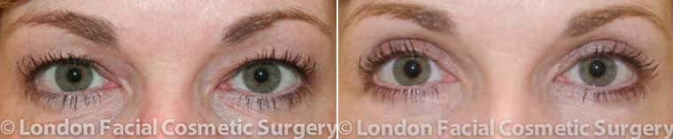 Photo of the patient’s eyes before and after the Blepharoplasty surgery. Patient 4 - Set 1