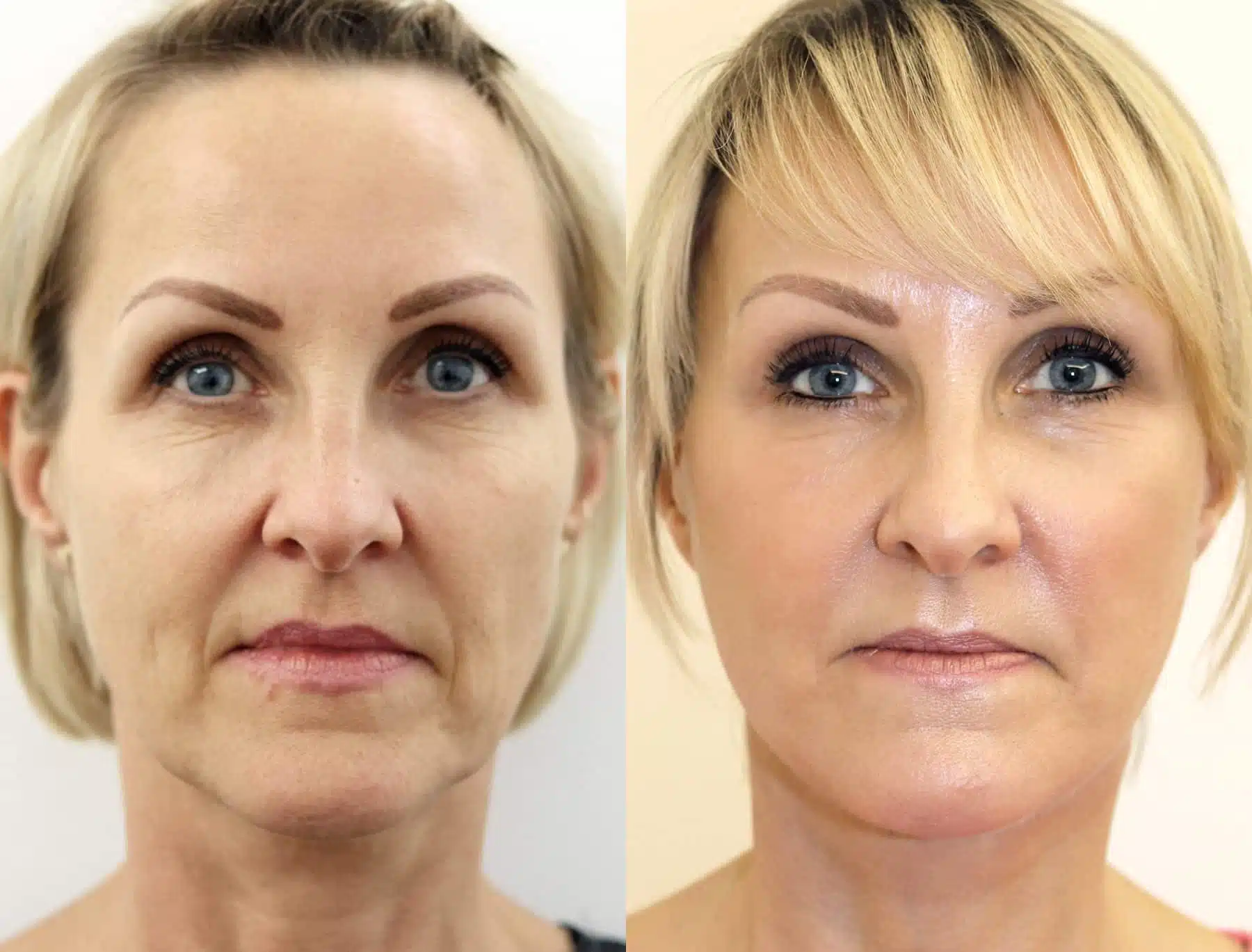Behind the Scenes: Unveiling the Pain Factor in a Full Facelift