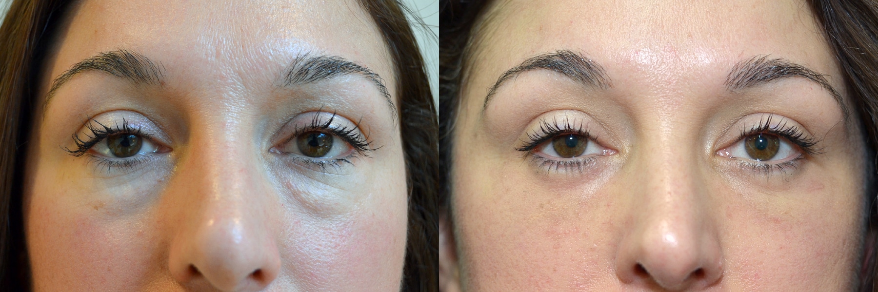 Blepharoplasty Patient 39