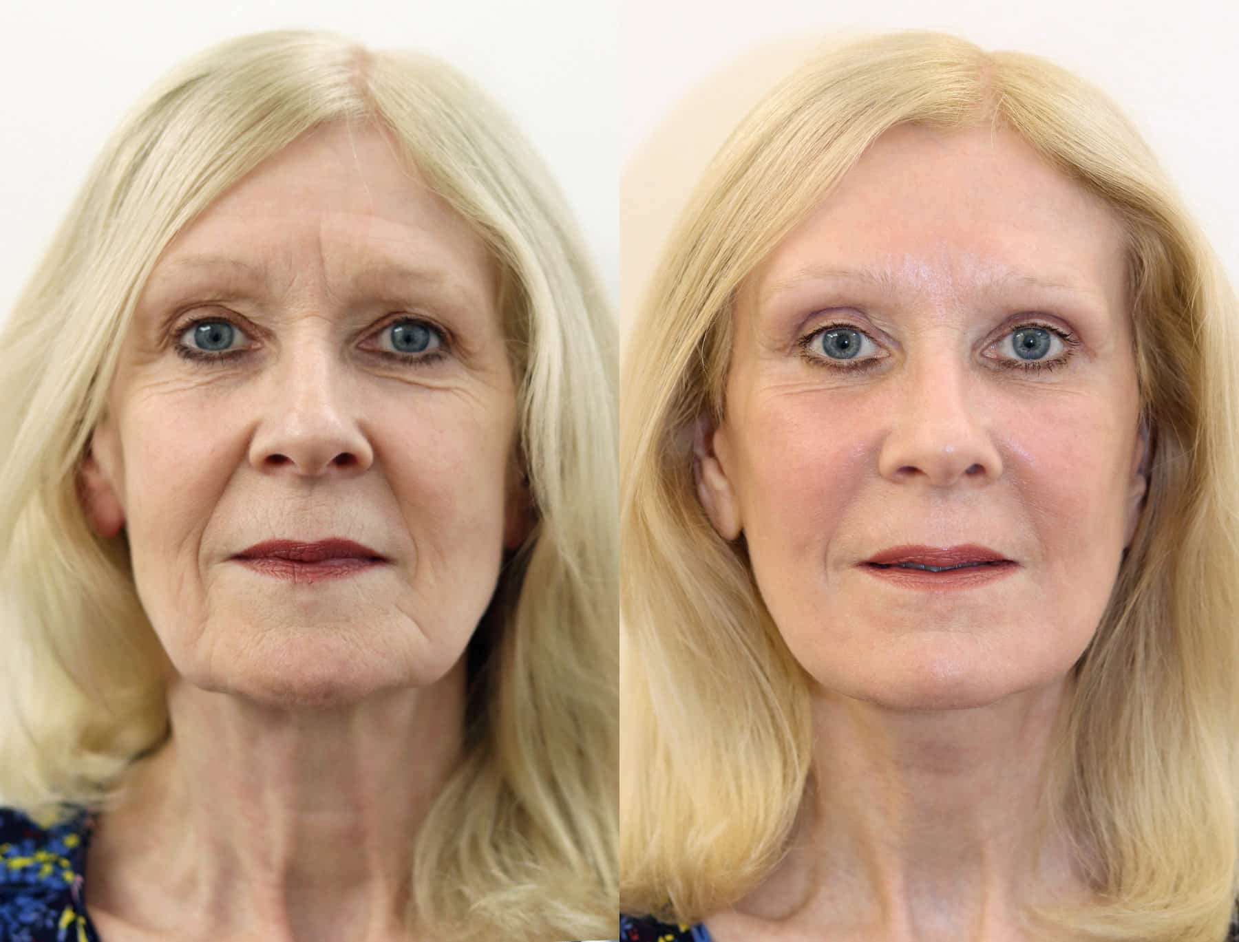 Face & Neck Lift – Patient Cases 2