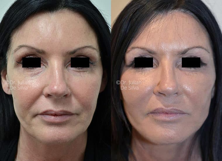 Face & Neck Lift – Patient Cases 3