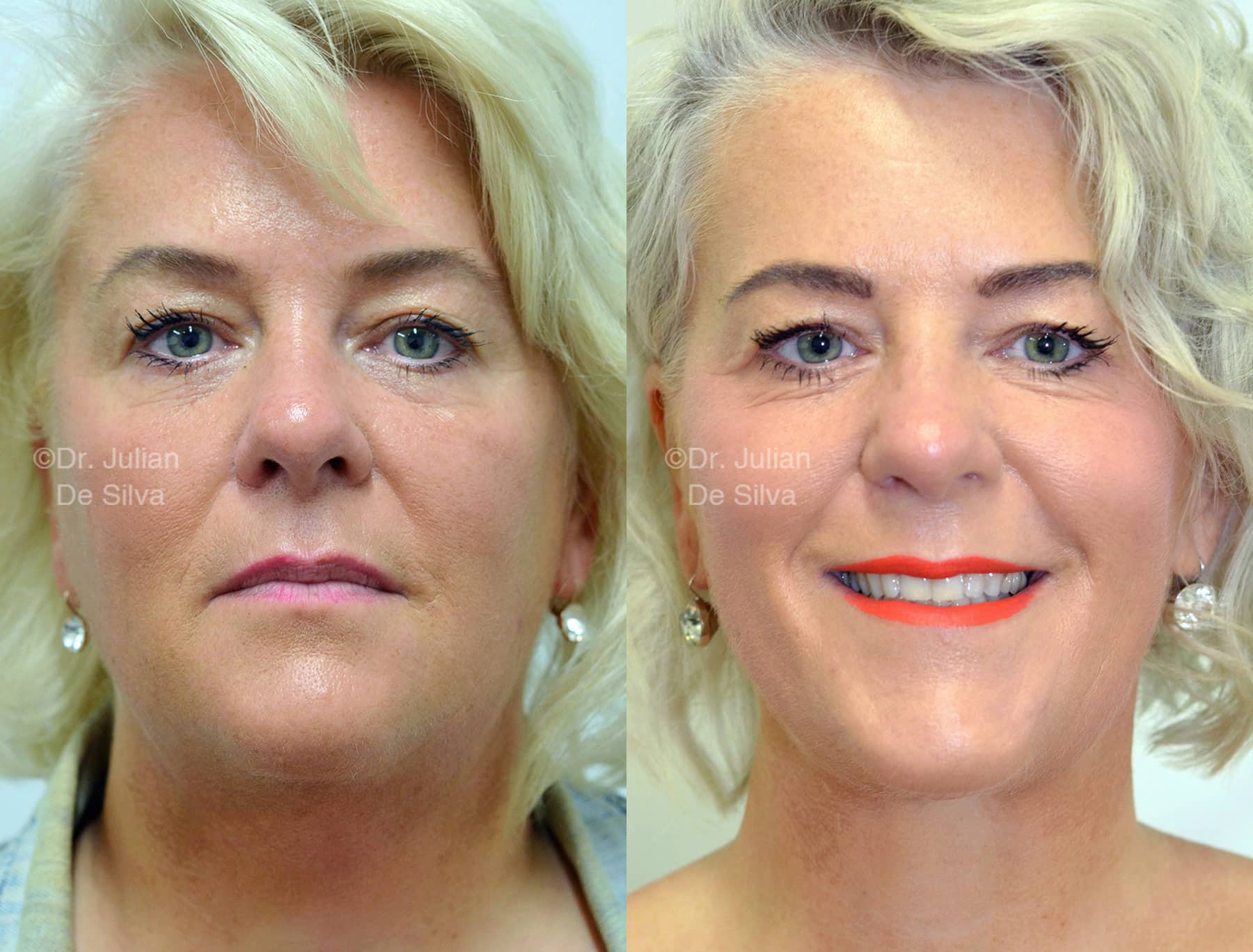 Face & Neck Lift REVISION– Patient Cases 1