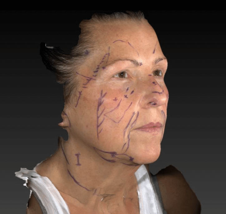 Facelift Consultation | London | Harley Street image 4