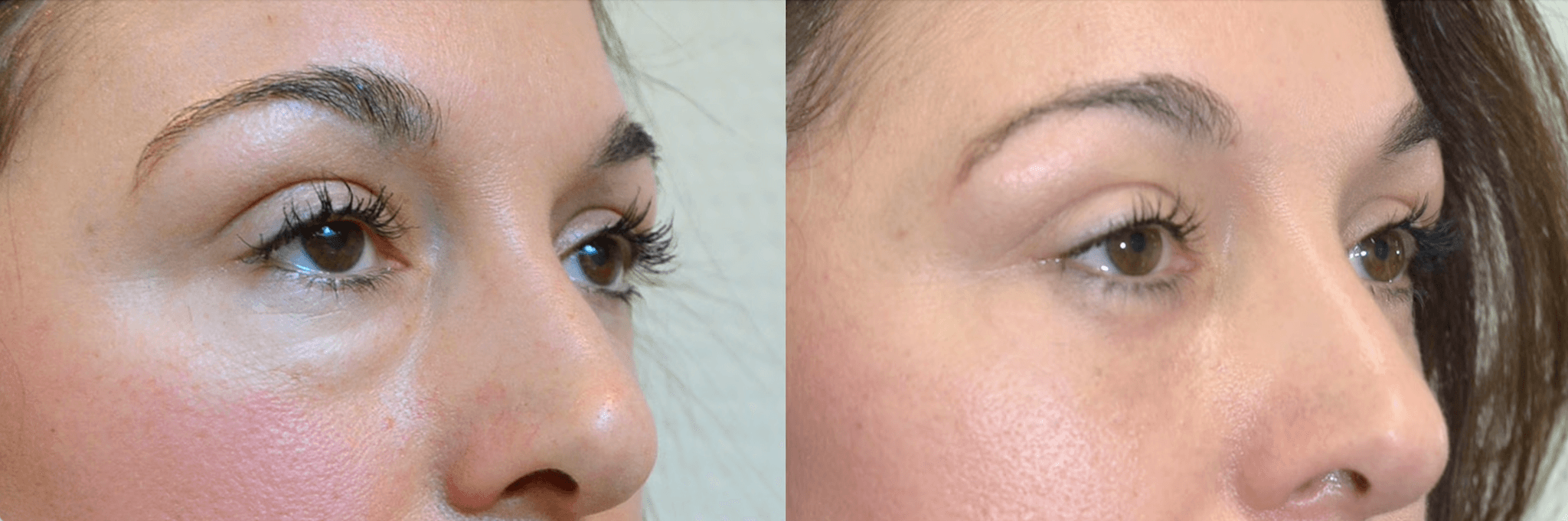What is lower blepharoplasty section image