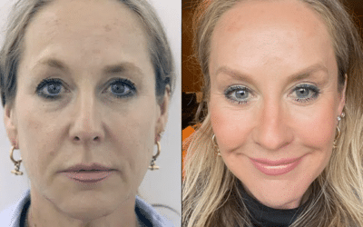 Vertical Face Restore: Solve All Your Problems With One Procedure