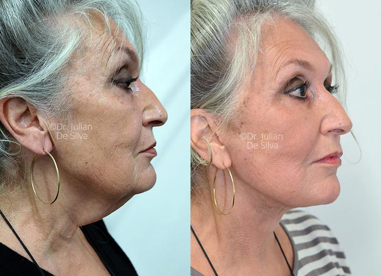 Facelift Before & After Photos - Facelift Surgery London