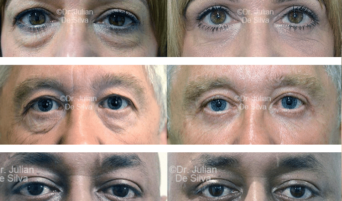 Eyelid surgery in Harley Street, London