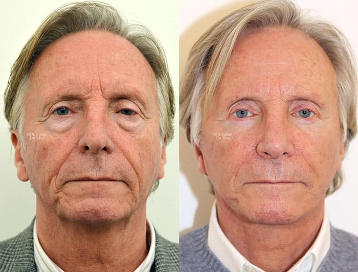 Male face, before and after Deep Plane Facelift treatment, front view, patient 1