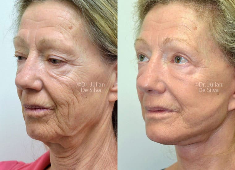 Female face, before and after Deep Plane Facelift treatment, oblique view, patient 2