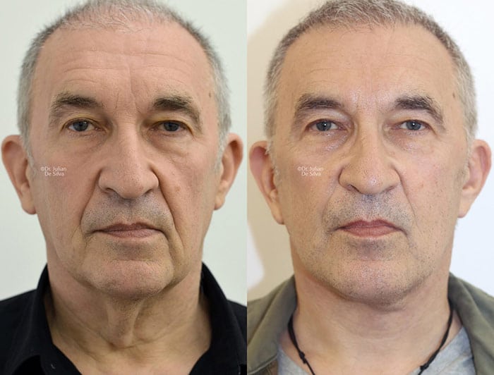 Male face, before and after Deep Plane Facelift treatment, front view, patient 3
