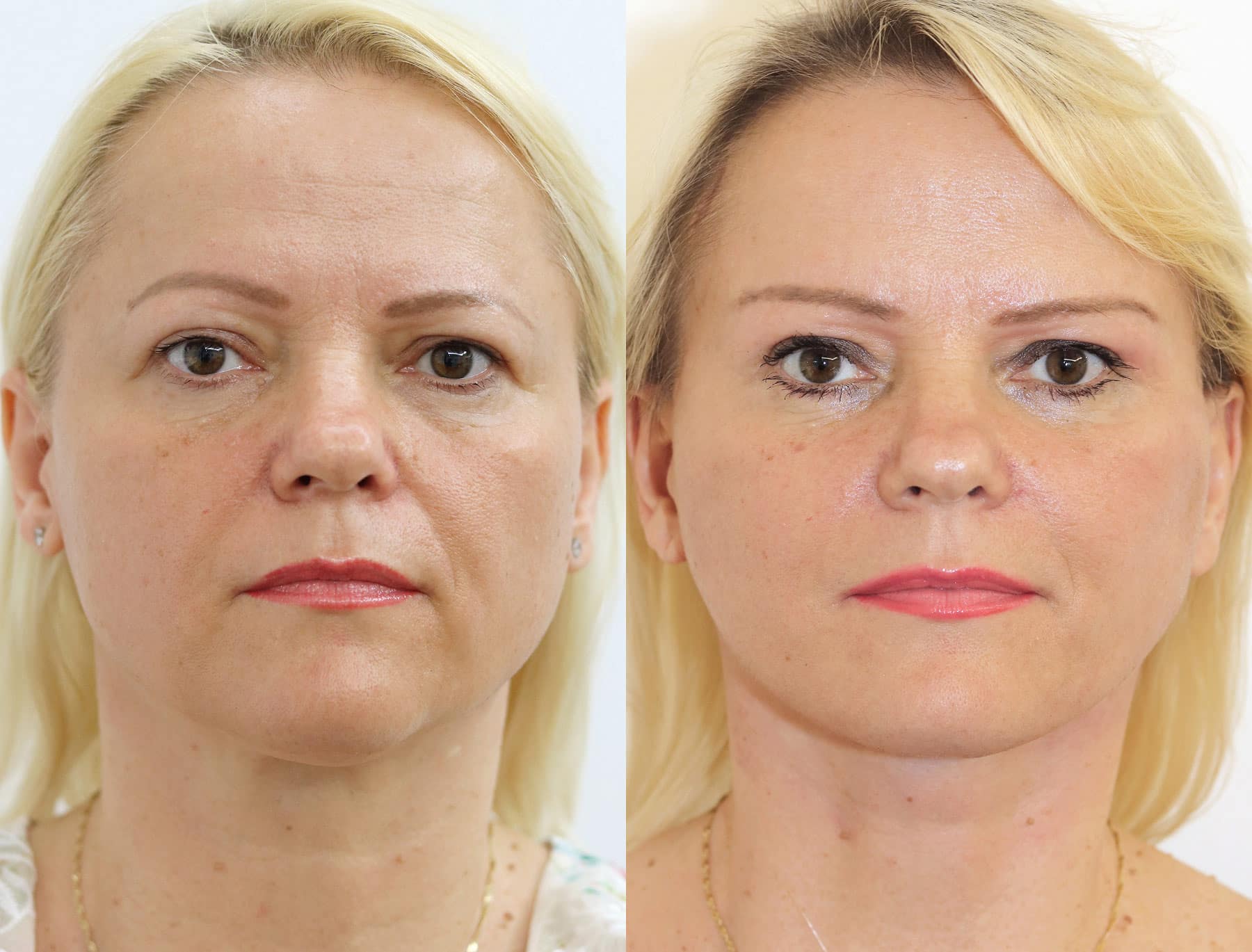 Dermal fillers help with maintenance after a facelift.