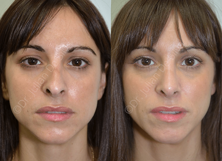 This woman received filler therapy and was dissatisfied with the shape of her nostrils and the asymmetry of her nose.