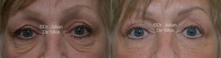 Before and After Photos: Female Blepharoplasty (2)
