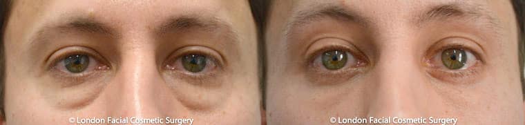 Before and After Photos: Blepharoplasty (1)