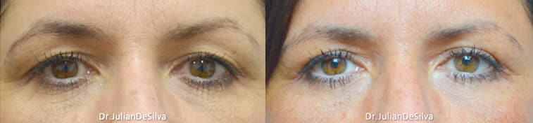 Before and After Photos: Female Blepharoplasty