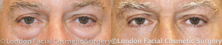 Before and After Photos: Male Blepharoplasty (1)