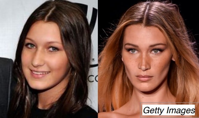 Supermodel Bella Hadid’s Teenage Rhinoplasty — before and after treatment