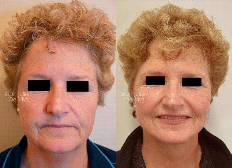Female face, before and after Mini Facelift treatment, front view, patient 5