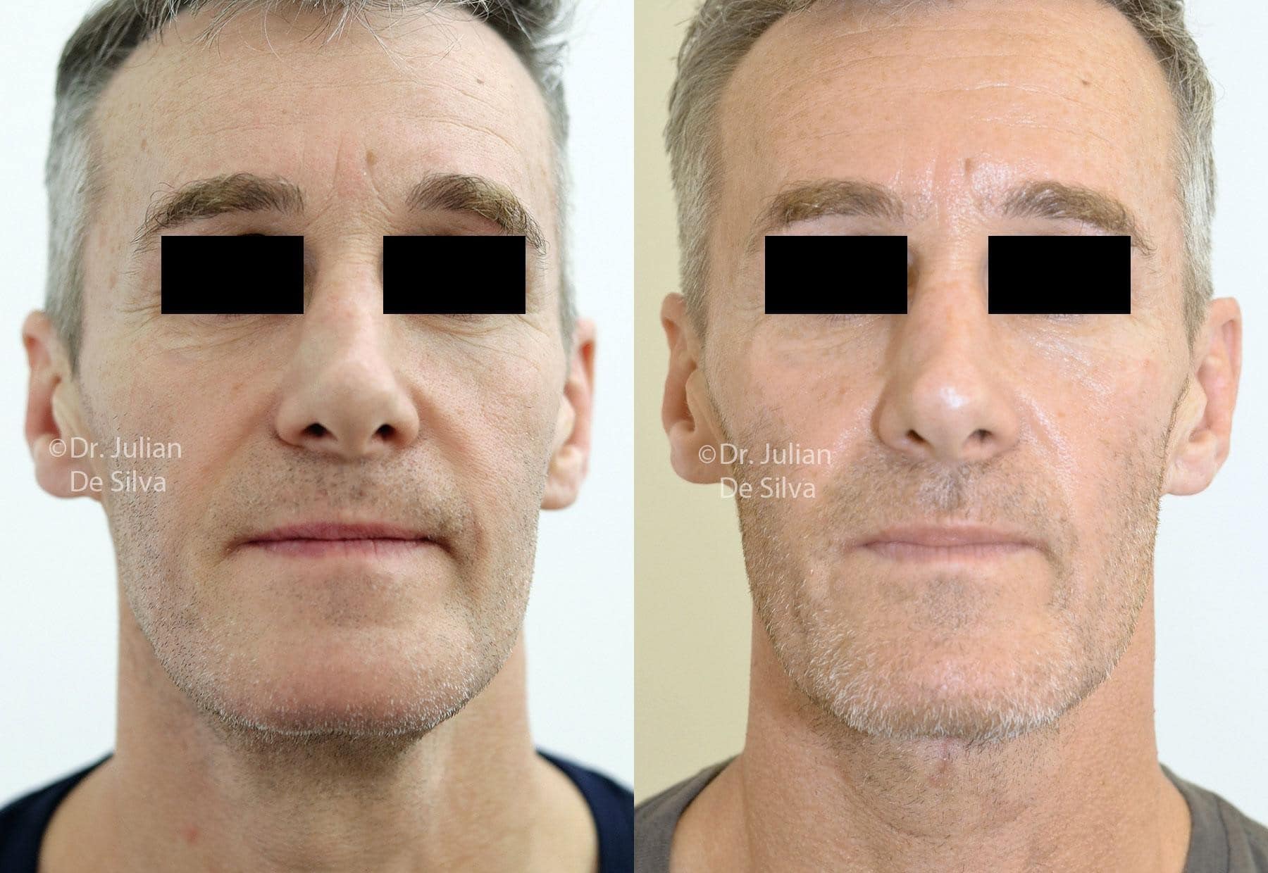 Male face, before and after Mini Facelift treatment, front view, patient 6