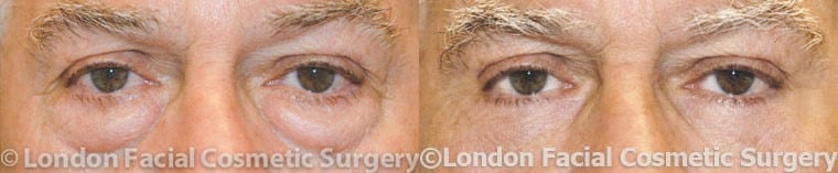 Male eye, before and after Eyelid Surgery treatment, front view, patient 2