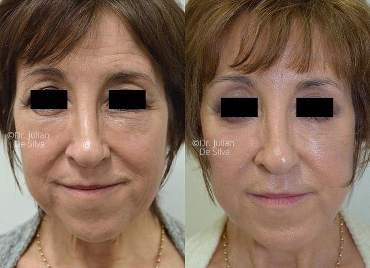 Female face, before and after Facelift treatment, front view, patient 4