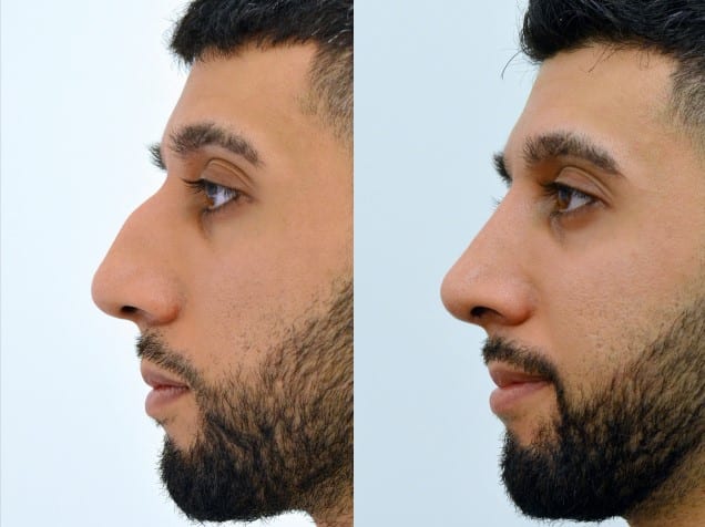 Risks of Teenage Rhinoplasty — male nose, before and after treatment, side view